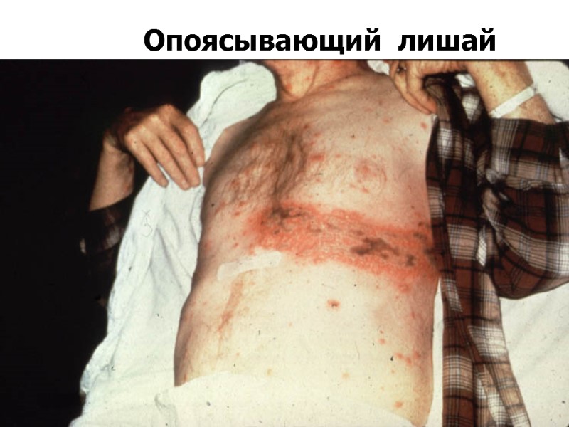 Опоясывающий  лишай